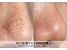 美容液導入【繰り返すいちご鼻改善にオススメ】毛穴洗浄&ヒト幹細胞導入¥9900