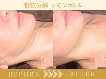 エステ ド フルール(Esthe de Fleur)/レモンボトルのBefore/After