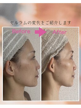 インフィニティ セルラム(INFINITY CELLULAM)/ビフォーアフター