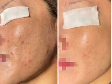 シャルテ(CialtE)/ハーブピーリング/ソフト