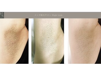 ハイリンク(High Link)/《両脇脱毛》before→after