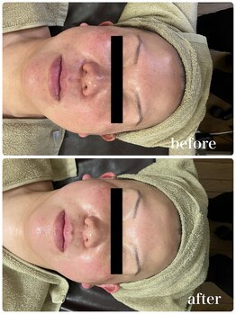 ジャスミン(Jasmin)/臍帯血幹細胞×NMN×AC-11