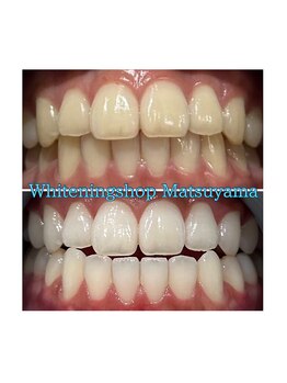 ホワイトニングショップ 松山店/色味の差が気になる方も大丈夫！