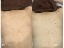 TD 鵜沼店/ハーブピーリング