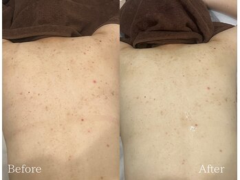 TD 鵜沼店/ハーブピーリング