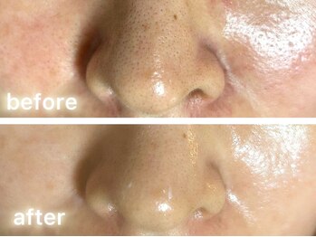 ホワイト ターコイズ/鼻と頬の毛穴&黒ずみ/施術前後