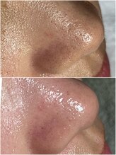 スパークル/毛穴ケア/ワックス脱毛