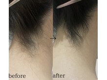 スパイリーア(Spiraea)/女性うなじBeforeAfter