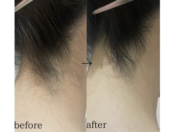 スパイリーア(Spiraea)/女性うなじBeforeAfter