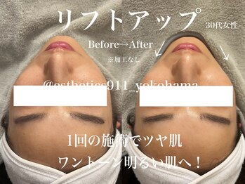 エステティックス ナインワンワン 横浜(Esthetics911) /引き締めリフトアップ！美白肌！