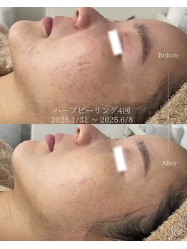 アニール(aniR)/ラミネーションピール/シワケア