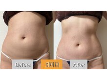 オレンジ(Orange)/1部位/痩身マシンBefore After