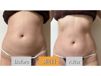 オレンジ(Orange)/1部位/痩身マシンBefore After