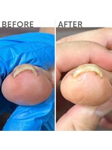 クオッカ(Quokka)/巻き爪ケア