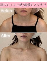 ココロ(COCORO)/肩のもっこり・鎖骨もスッキリ