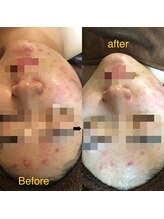 サロンシャイン(Salon Shine)/ハーバルピールレベル7