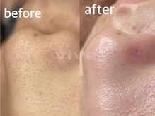 ヴィーヴ 京橋(vive)/【韓国式3D毛穴洗浄】