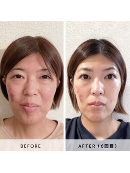 サロン レインボー(SALON RAINBOW)/小顔集中コース Before/After