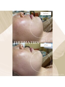 薫風/サーマトリックス/30代