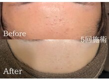 リネ(Rine)/根本肌質改善！！