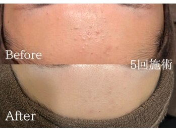 リネ(Rine)/根本肌質改善！！