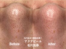 リル 和歌山市店(lilou)の雰囲気(毛穴詰まり・ざらつきにはアクアピールで徹底改善!)