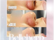 ベルハーブ(Belle herb)/20代/ピーリング/毛穴ニキビ