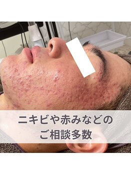 ニキビケア研究所 横浜店/もうニキビや跡で悩まない肌へ!