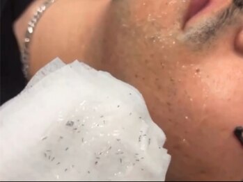 ボス 津店(BOSS)/施術後に抜けたヒゲ　#ヒゲ脱毛