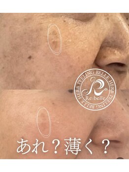 エクセレントビューティーサロン 艶(EN)/即効性！シミケア・トーンアップ