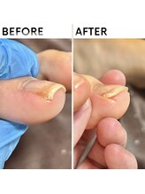 クオッカ(Quokka)/巻き爪ケア