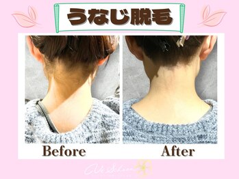 ヴィ シェーン(Vi Schoen)/うなじBefore/After 【U型】