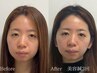 《SETクーポン》【歪み改善】顔全体美容鍼＋歪み小顔矯正◎通常¥26400→¥8800