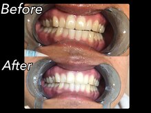 ホワイトニングビューティー 吉祥寺店/症例写真_2回来店されたお客様