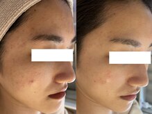 エミラン(Emiran)の雰囲気（話題のララピール正規取扱店ハリ艶・くすみ・赤み・ニキビケア）