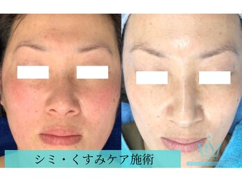 リメイクビューティークリニック(REMAKE BEAUTY CLINIC)/５回：赤ら顔、シミにアプローチ