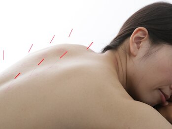 ゲンキプラス 骨盤ラボ イオンモールかほく店(GENKIPlus)/鍼灸で根本改善