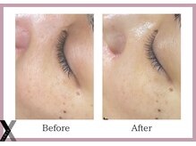 クロス(Xcross)/ハーブピーリング【毛穴/渋谷】