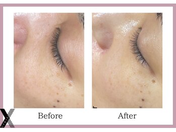 クロス(Xcross)/ハーブピーリング【毛穴/渋谷】