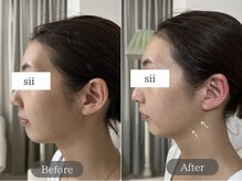 シイ(total skin beaute sii)/30代　リフティング ※施術1回