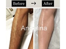 サロン ド アンジェリーナ(Salon de Angelina)/17才男子　激落ち！ムダ毛卒業！