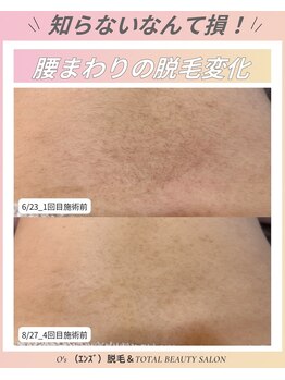 エンズ(O's)/ムダ毛とお肌の同時ケア