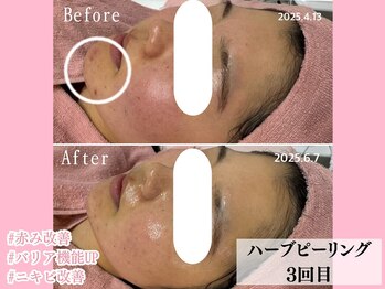 エンクリニカルラボ 三宮店(E&N CLINICAL LABO)/幹細胞ハーブピーリング