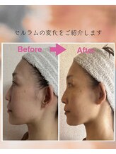 インフィニティ セルラム(INFINITY CELLULAM)/ビフォーアフター