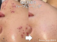 ボニータアンジュ 恵比寿(Bonita Ange)の雰囲気(剥離ありオーダーメイドハーブピーリング|詳細フォトギャラリー)