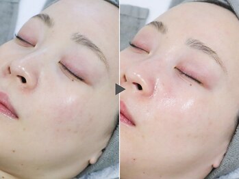 クリード(CLEAD)/ハイドラ+ハイドロジェリー