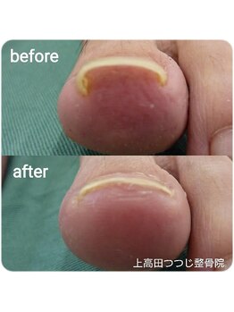 上高田つつじ整体院/巻き爪　ネイルケア　例