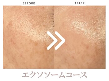 エステティックサロン ラ ベルタ(Esthetic Salon La Belta)/エクソソームコース（1回）