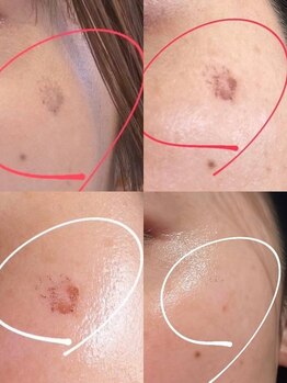 ルコア ドゥ(rucor doux)/スポット照射で気になる所撃退！