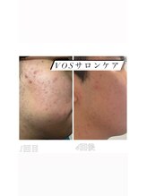 ビューティー アディクト(Beauty addict)/肌質が激変する！VOSサロンケア